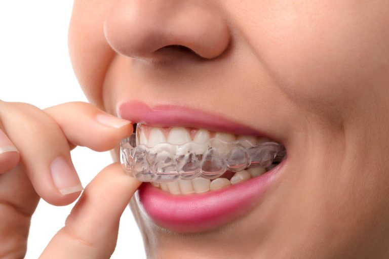 Clear Aligners – The Incredible Journey of Modern Teeth Straightening